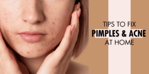 Acne and Pimples