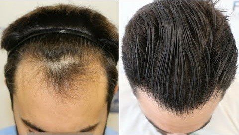 hair transplants